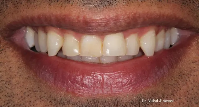 Before: Veneers on Upper Front Teeth