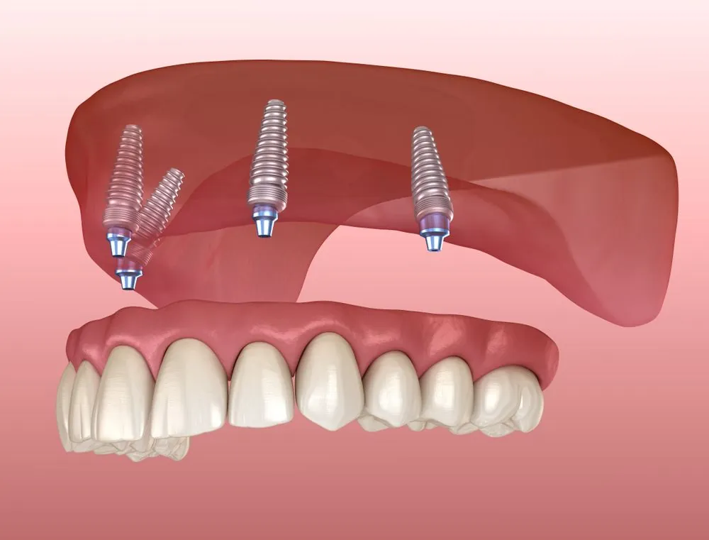 Illustration of a full-arch bridge on four dental implants