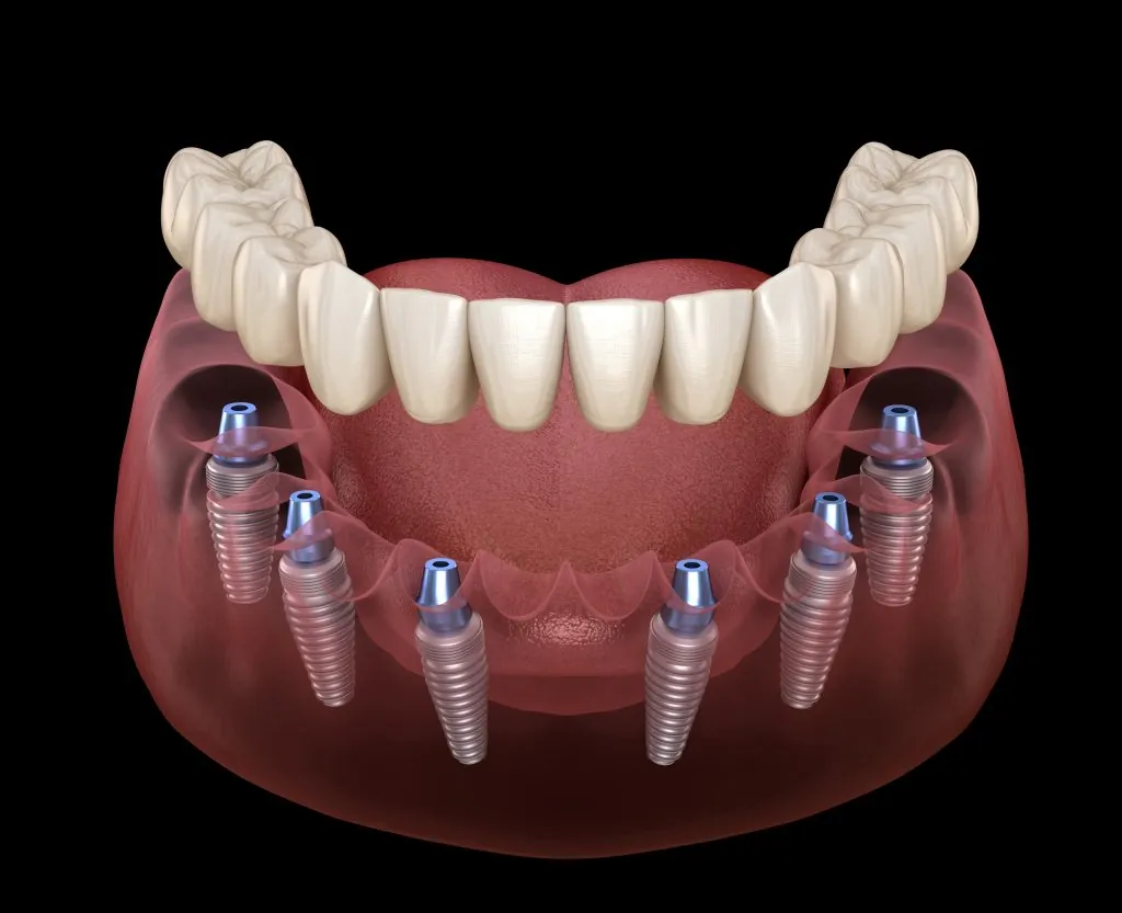 Illustration of a full arch of teeth on six dental implants