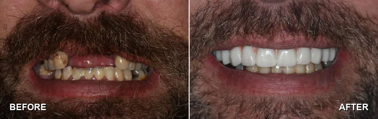 Before and after: a full arch restored with All-on-4 dental implants