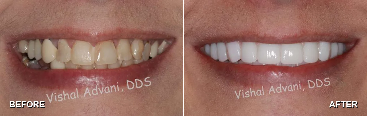 Before and after: upper and lower All-on-X implants and bridges
