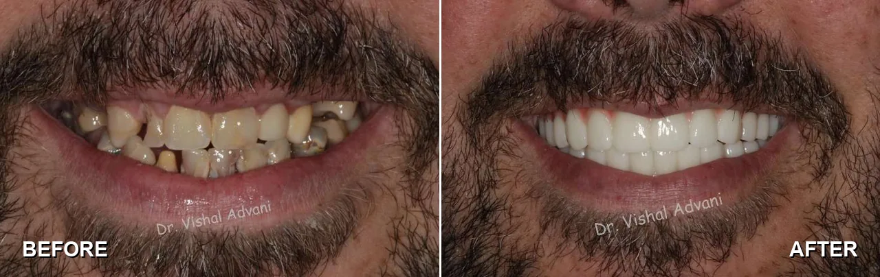 Before and after: both arches restored with All-on-X implants