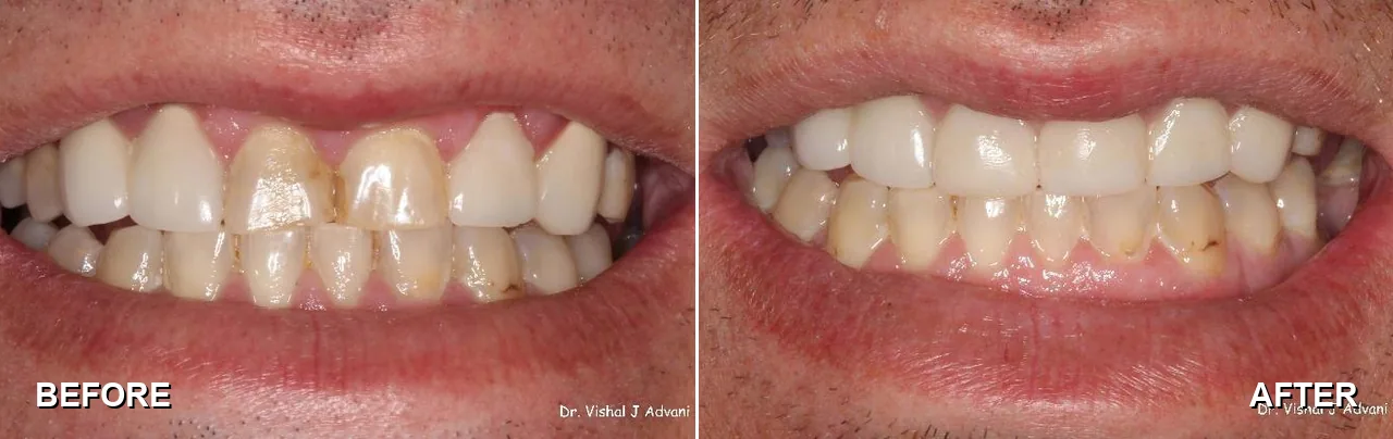 Before and after: crowns on dark, chipped front teeth