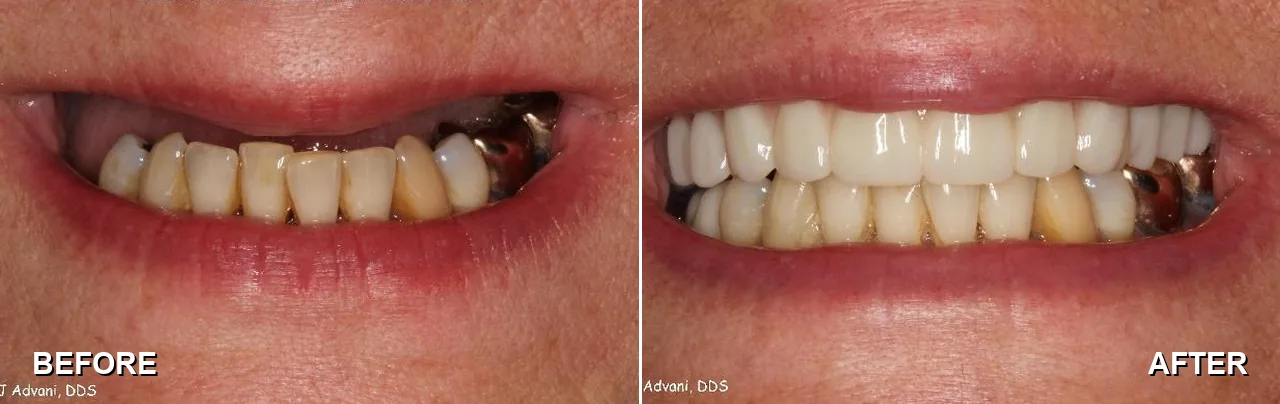 Before and after: an implant bridge replacing missing upper teeth