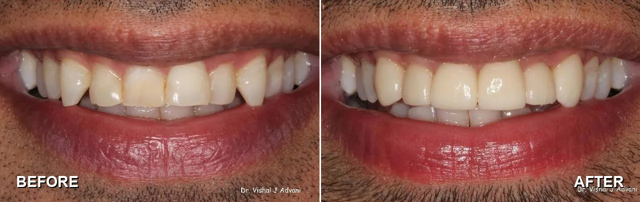 Before and after: veneers on upper front teeth