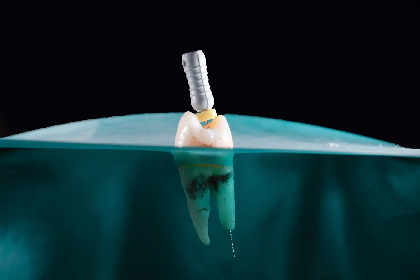 Illustration of a dental implant placed in grafted bone