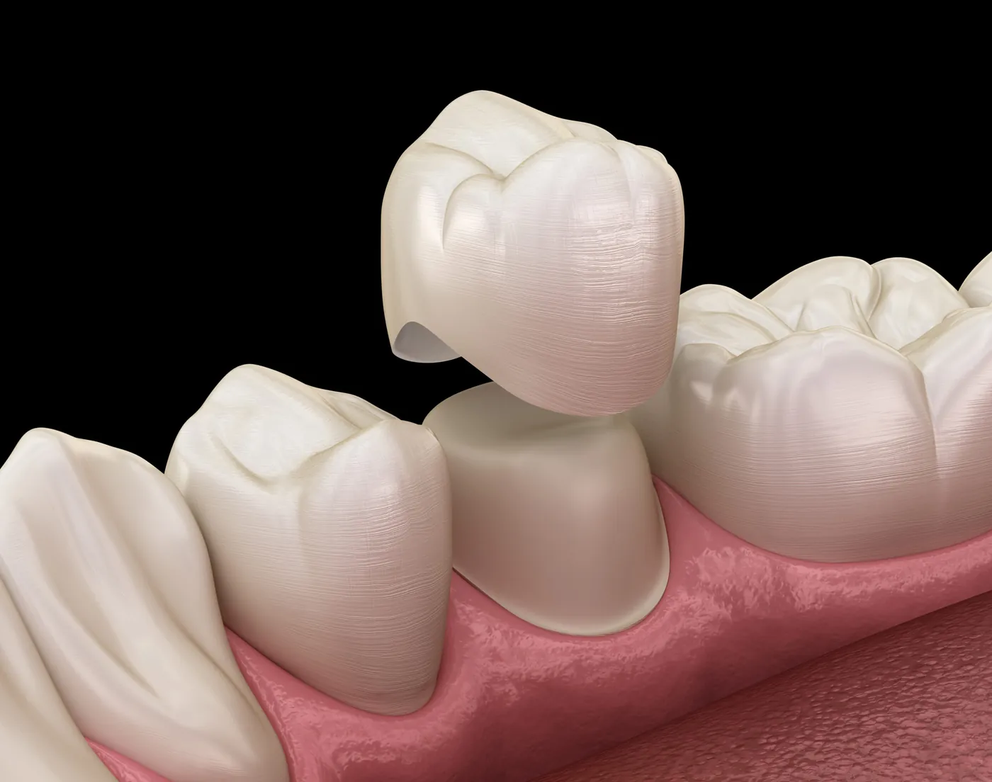 Illustration of a dental crown being placed over a prepared tooth