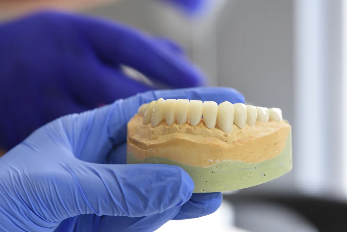 Gloved hand holding a full-arch implant bridge model