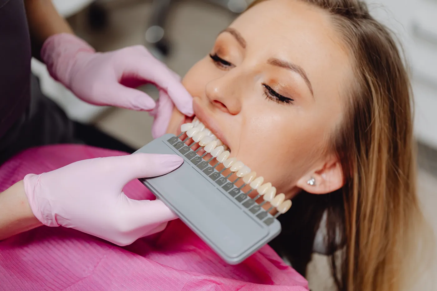 Matching a tooth shade guide to a patient’s smile