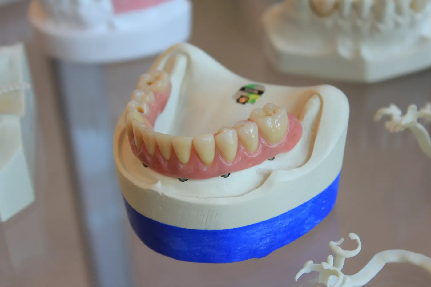 Model of a snap-on denture that attaches to implants