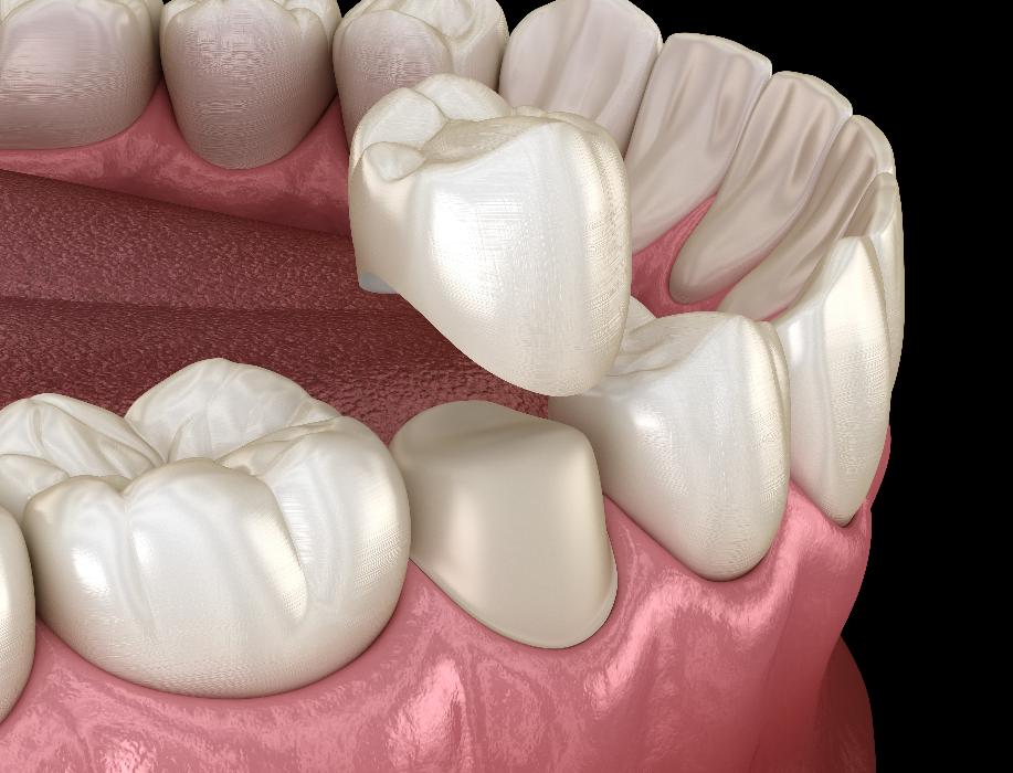close up of dental crown | dental crowns elk grove village il