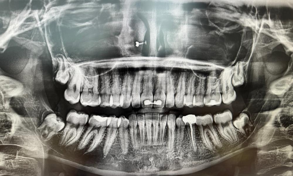 Are my wisdom teeth too difficult to remove?