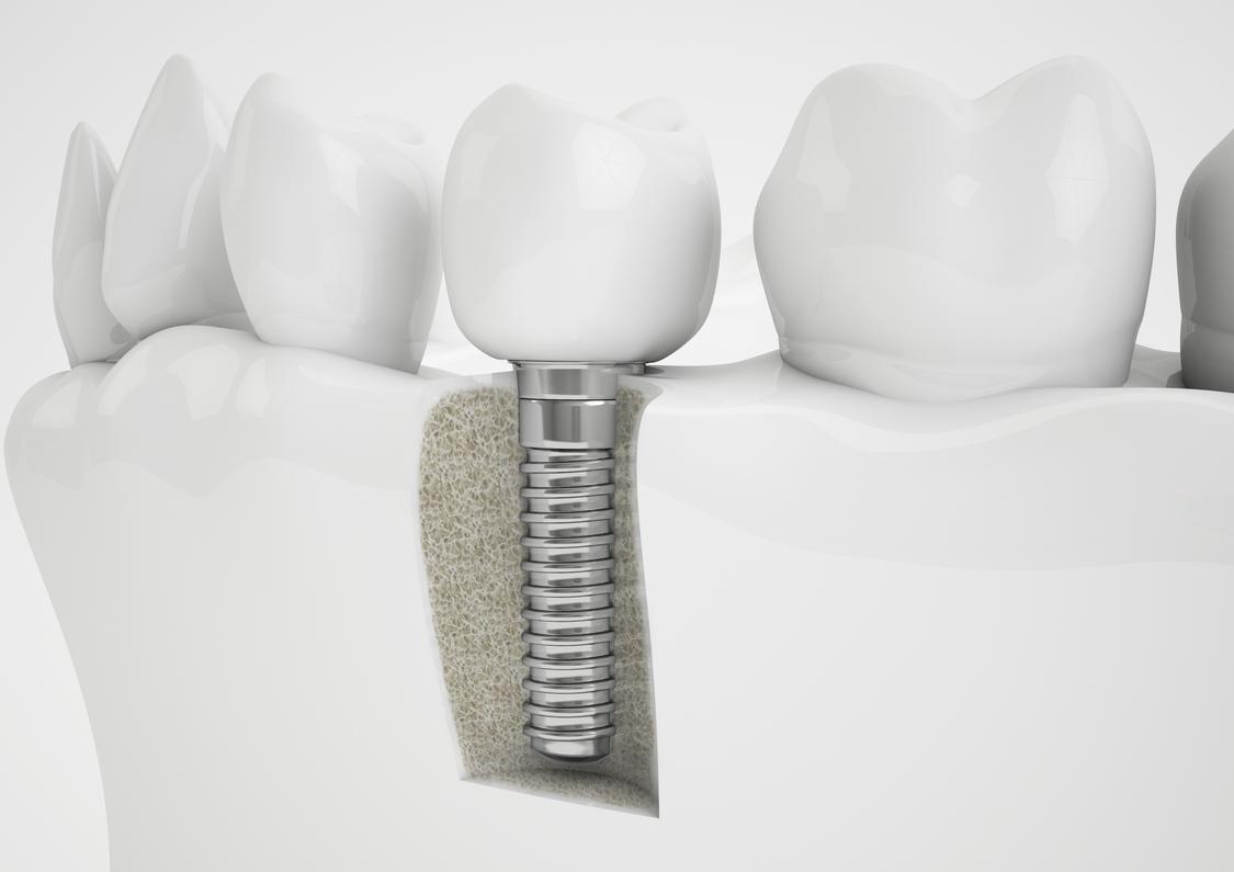 Dental implants elk grove village il