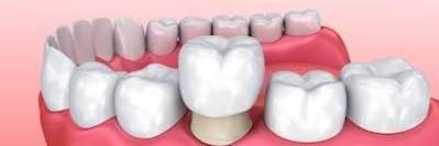 An illustration of a dental crown at Elk Grove Smile Center