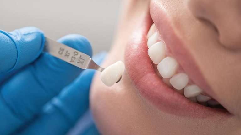 Dental veneer in Elk Grove Village