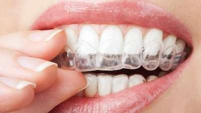 Patient putting Invisalign clear aligners in Elk Grove village