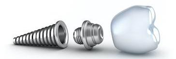 An illustration of a dental implant in B Elk Grove Village, IL