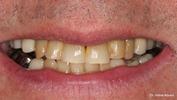 before teeth whitening in elk grove village il