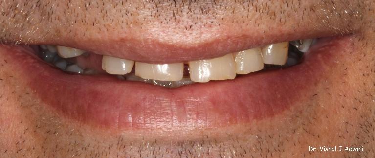 Extraction-of-Front-Tooth-and-replacement-with-an-Implant-and-Crown-Before-Image