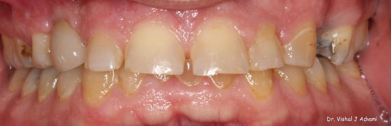 dental crown and implant elk grove village il