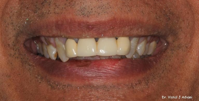 before front dental bridge elk grove village il