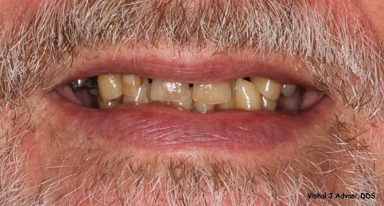 Cosmetic-Dentistry-All-Ceramic-Bridge-and-White-Tooth-colored-Filling-Before-Image