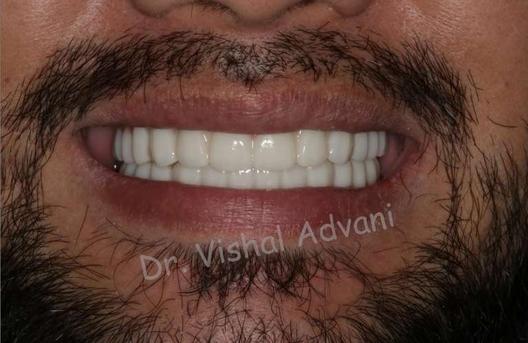 dental implants and all-zirconia bridges done to replace multiple loose teeth