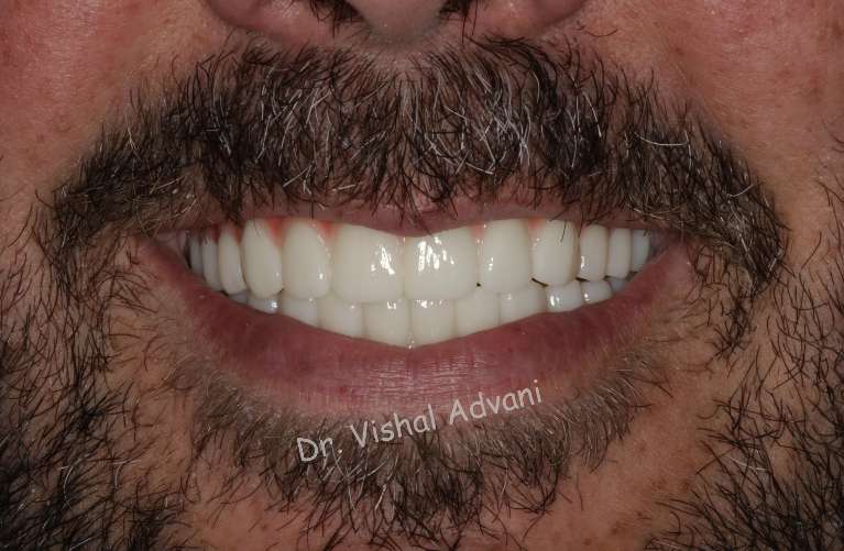 Upper-Lower-All-on-X-Transformation-After-Image