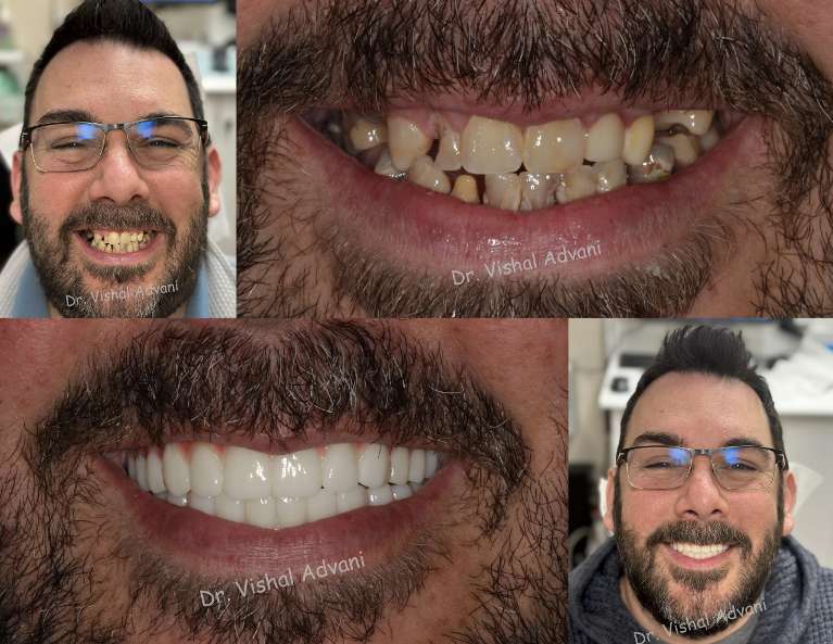 a photo collage of before and after a Upper & Lower All-on-X Transformation