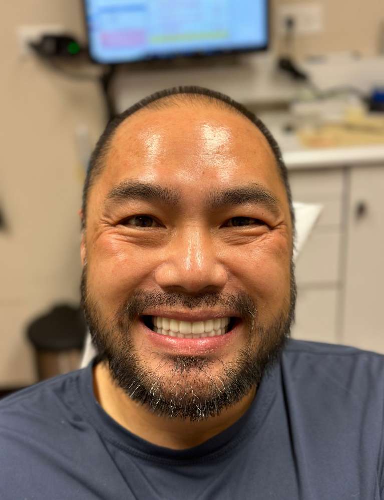 This patient had dental implants and all-zirconia bridges done to replace multiple loose teeth