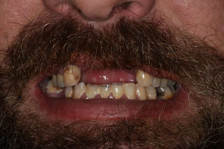 All-on-4-Dental-Implant-Transformation-Before-Image