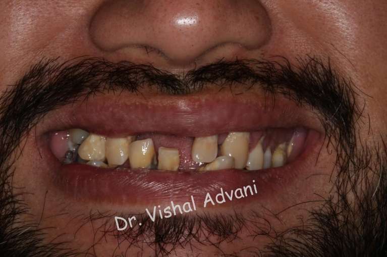 Before dental implants and all-zirconia bridges done to replace multiple loose teeth