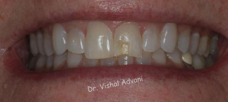 Cosmetic-Bonding-to-Fix-Broken-Tooth-Before-Image