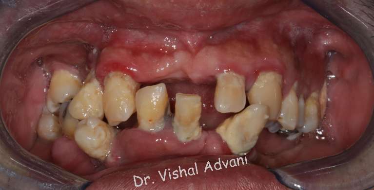 Before photo - multiple loose teeth