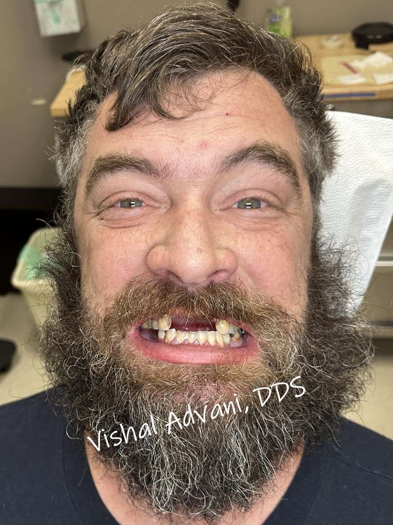 A patient with multiple missing and broken teeth