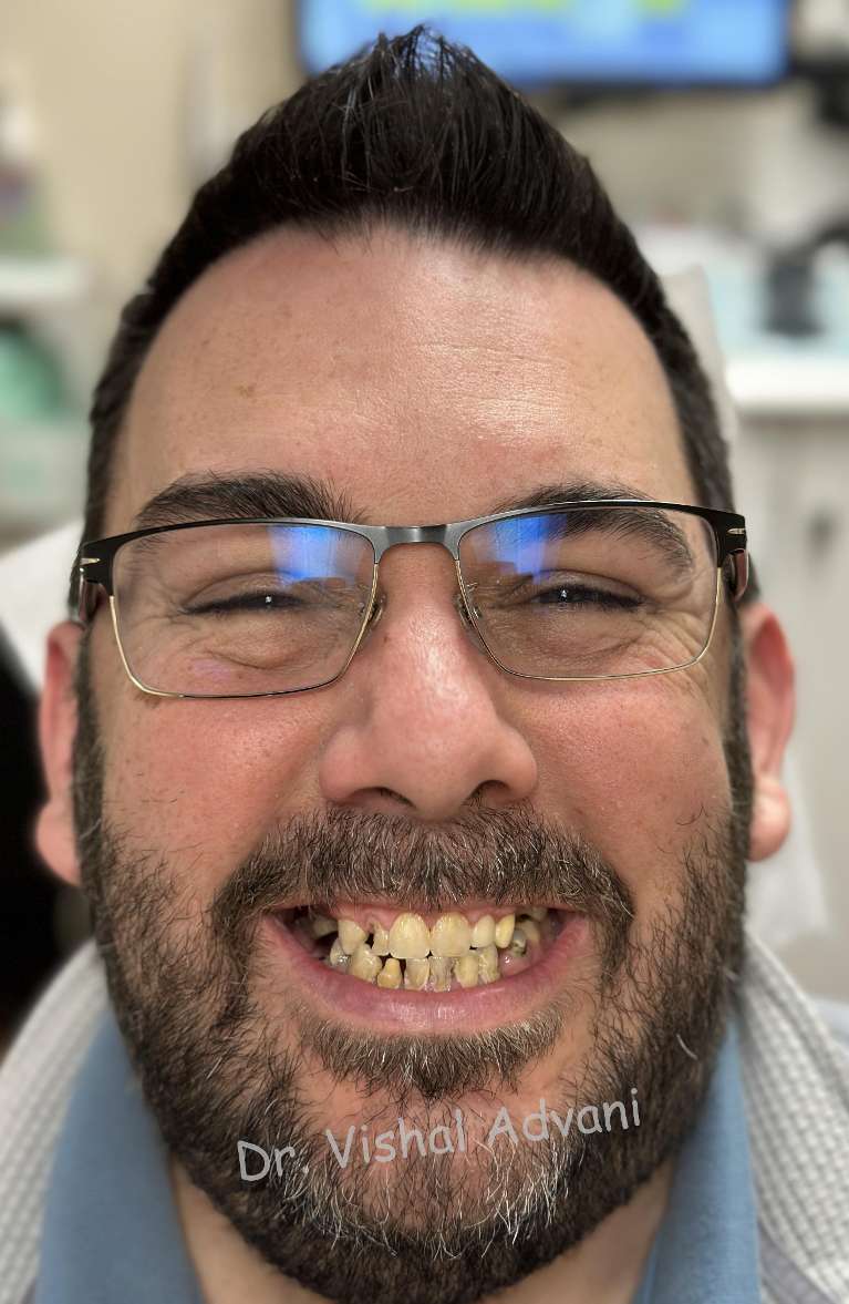 A photo of a patient an Upper & Lower All-on-X Transformation