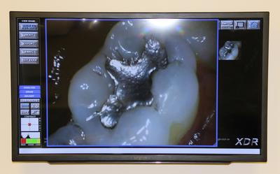 Photo of Intra-oral camera used at Elk Grove Smile Center