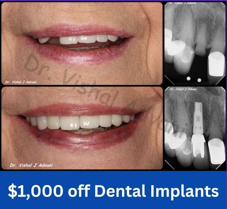 Patient's teeth before and after getting dental implants from Elk Grove Smile Center