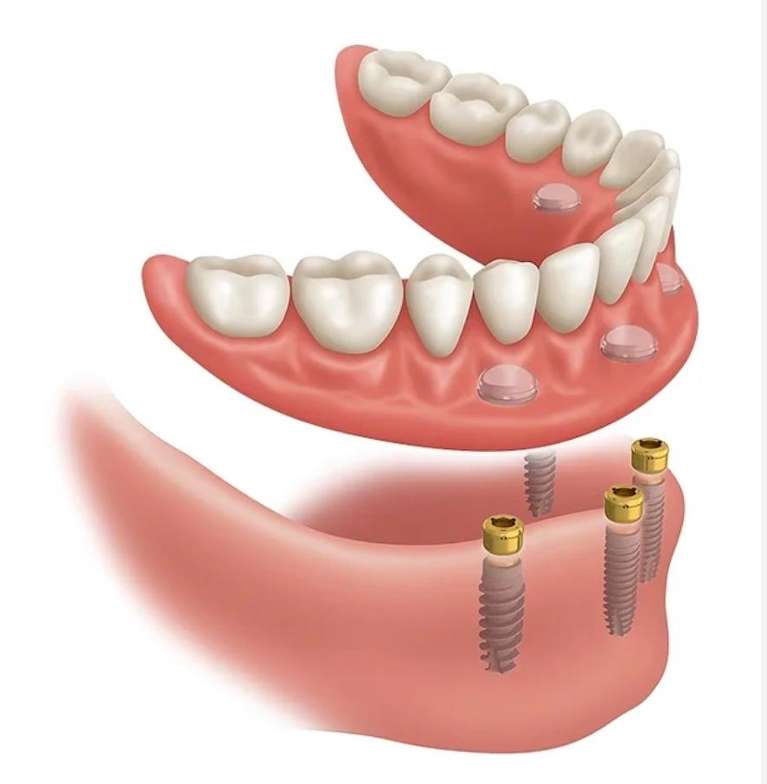 Snap-on Denture illustration