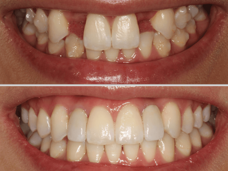 A before and after photo of a patient after Dental Implant treatment